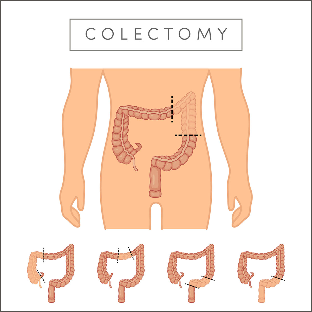 Colorectal Cancer - Lee Surgery & Endoscopy Singapore
